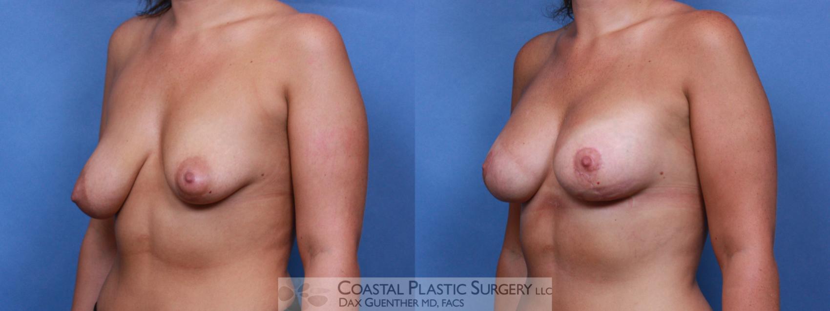 Before & After Breast Asymmetry Case 95 View #2 View in Hingham, Boston & Nantucket, MA