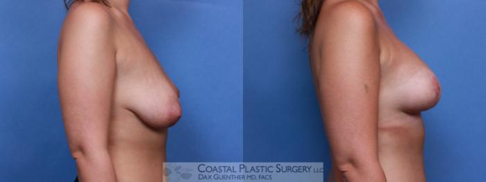 Before & After Breast Asymmetry Case 95 View #3 View in Boston, MA
