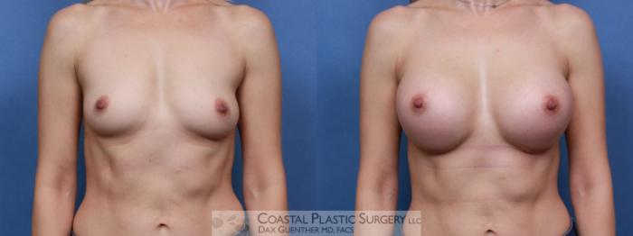 Before & After Breast Augmentation Case 101 Front View in Boston, MA