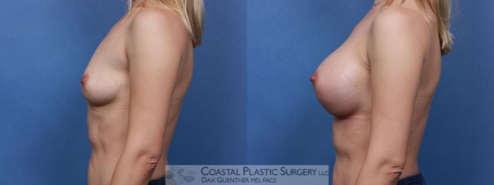Before & After Breast Augmentation Case 101 Left Side View in Boston, MA