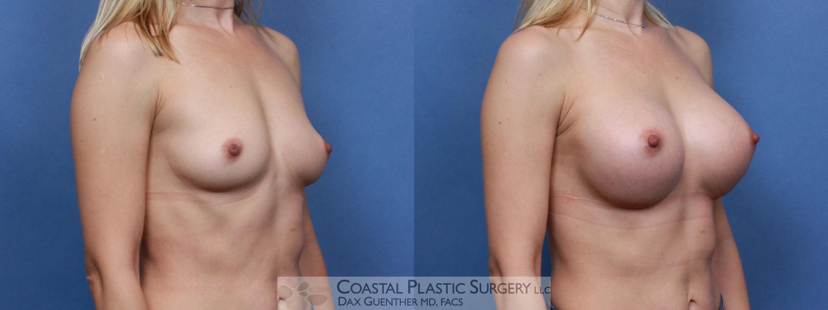 Before & After Breast Augmentation Case 101 Right Oblique View in Hingham, Boston & Nantucket, MA