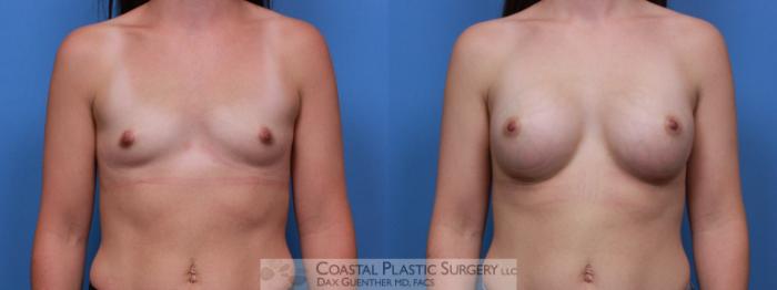 Before & After Breast Augmentation Case 102 Front View in Boston, MA