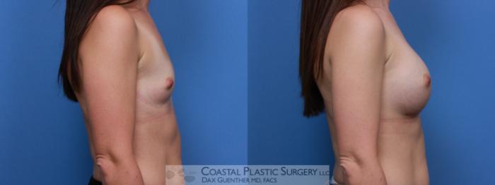 Before & After Breast Augmentation Case 102 Right Side View in Boston, MA