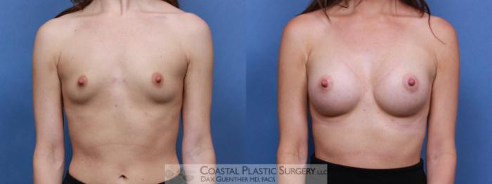 Before & After Breast Augmentation Case 103 Front View in Boston, MA