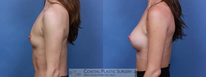 Before & After Breast Augmentation Case 103 Left Side View in Boston, MA