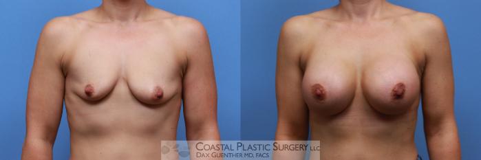 Before & After Breast Augmentation Case 122 Front View in Boston, MA