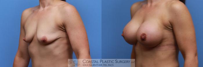 Before & After Breast Augmentation Case 122 Left Oblique View in Boston, MA