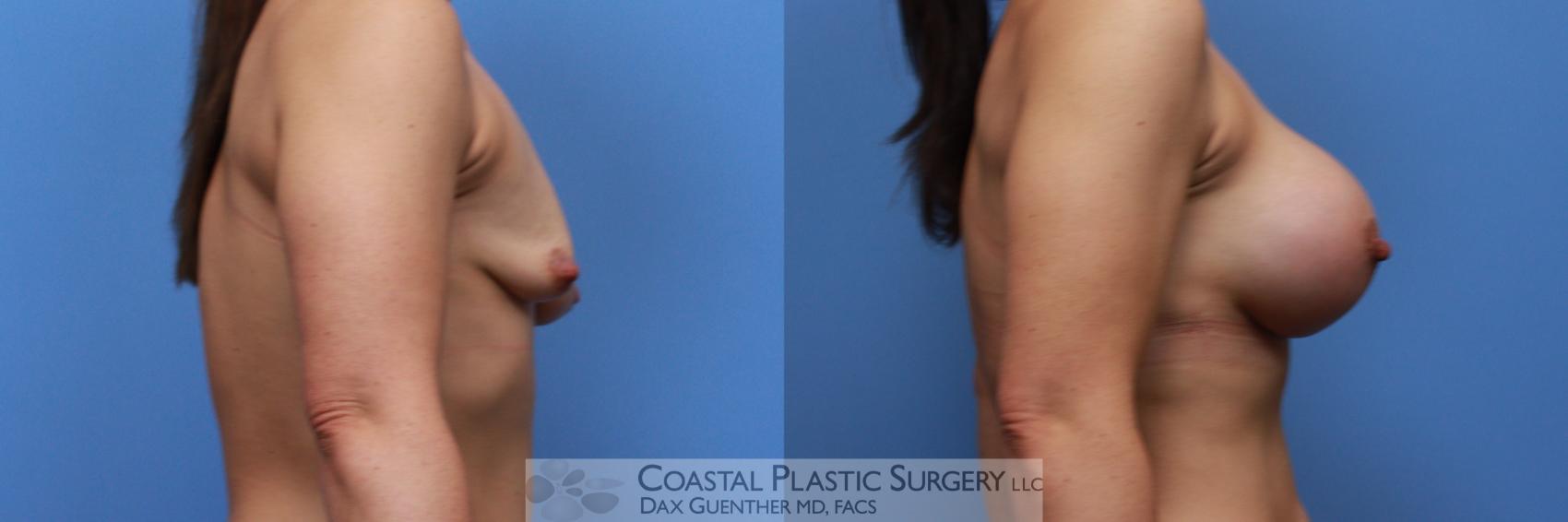 Before & After Breast Augmentation Case 122 Right Side View in Boston, MA