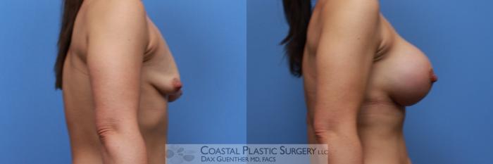 Before & After Breast Augmentation Case 122 Right Side View in Boston, MA