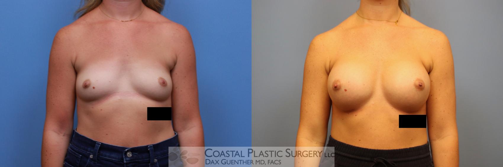Before & After Breast Augmentation Case 133 Front View in Boston, MA