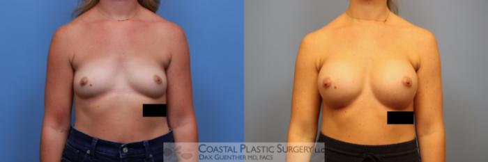Before & After Breast Augmentation Case 133 Front View in Boston, MA