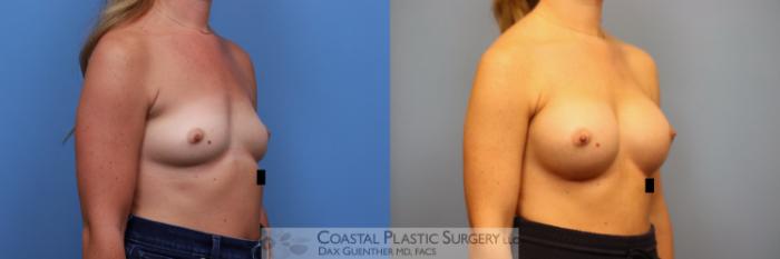 Before & After Breast Augmentation Case 133 Right Oblique View in Boston, MA