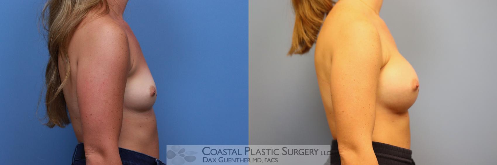 Before & After Breast Augmentation Case 133 Right Side View in Boston, MA
