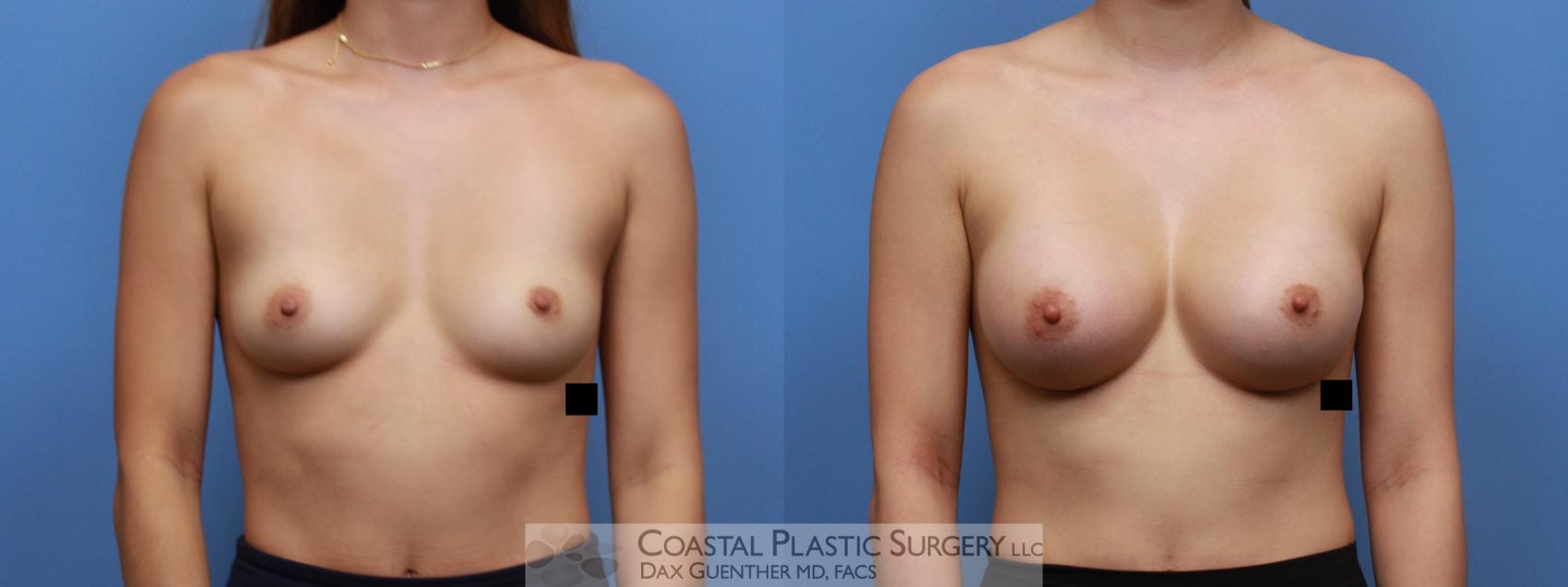 Before & After Breast Augmentation Case 135 Front View in Boston, MA