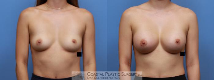 Before & After Breast Augmentation Case 135 Front View in Boston, MA