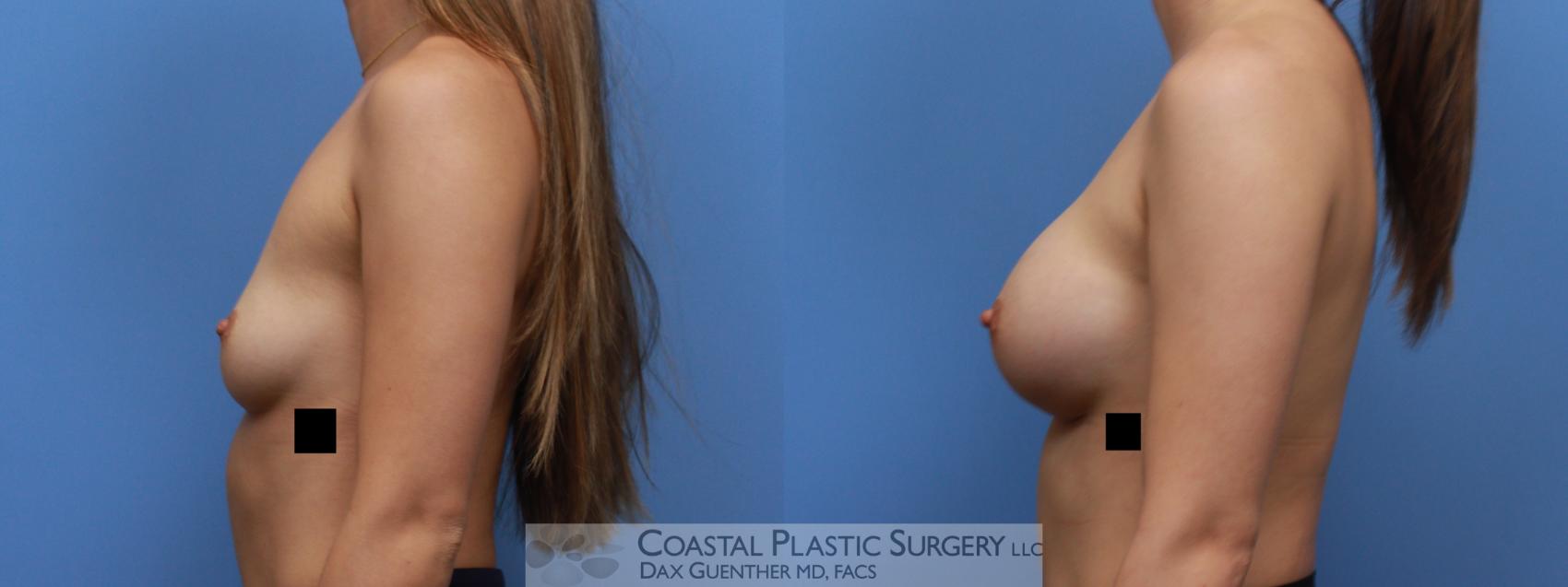 Before & After Breast Augmentation Case 135 Left Side View in Boston, MA