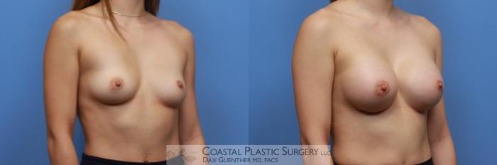 Before & After Breast Augmentation Case 135 Right Oblique View in Boston, MA