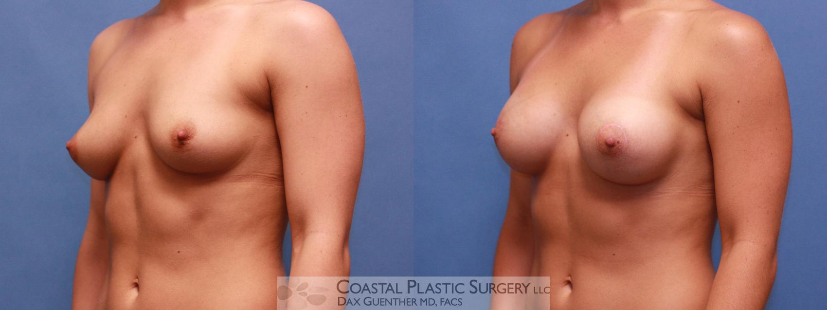 Before & After Breast Augmentation Case 19 View #1 View in Hingham, MA