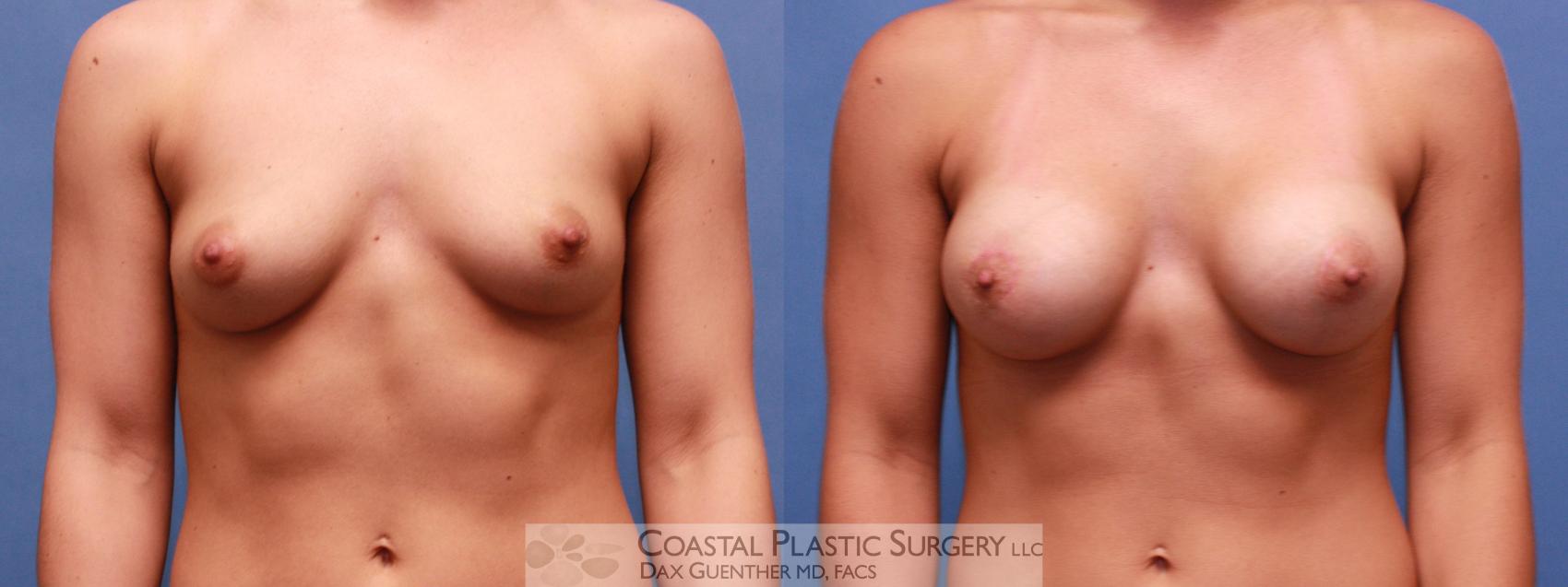 Before & After Breast Augmentation Case 19 View #2 View in Boston, MA