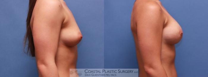 Before & After Breast Augmentation Case 19 View #3 View in Hingham, MA