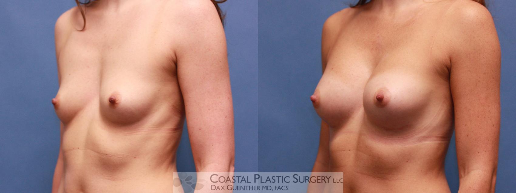 Before & After Breast Augmentation Case 34 View #1 View in Hingham, MA