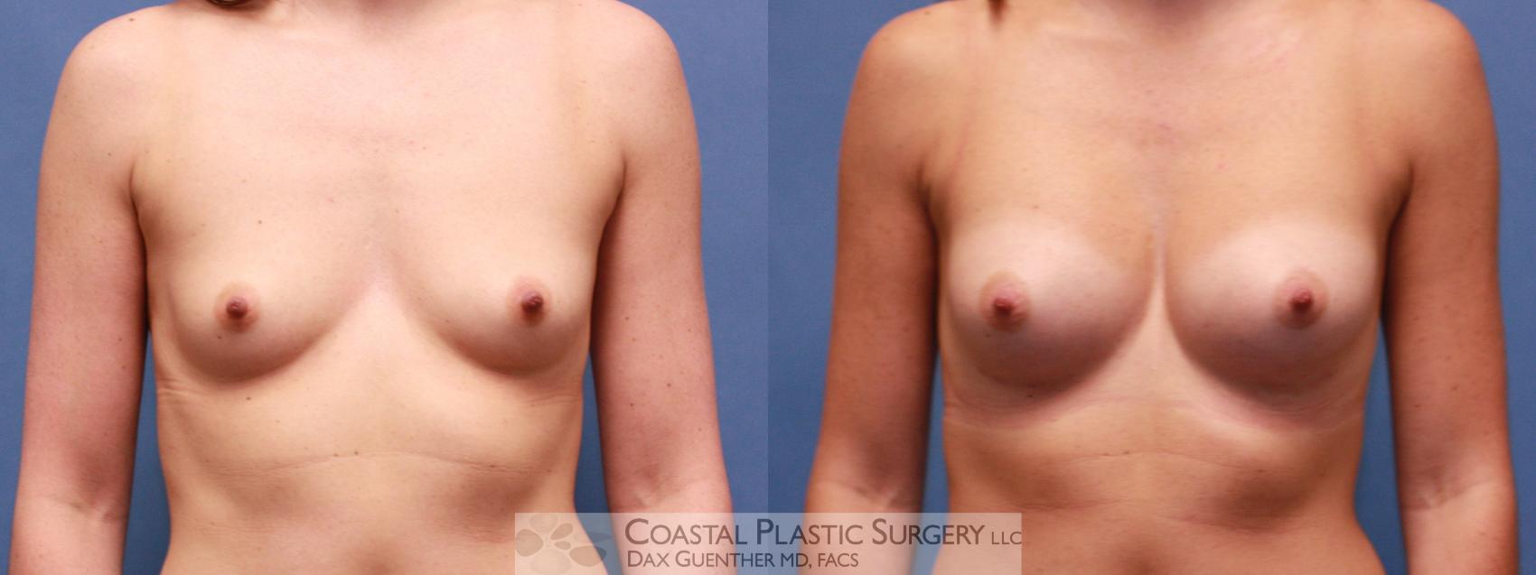 Before & After Breast Augmentation Case 34 View #2 View in Boston, MA