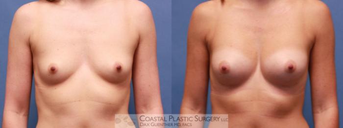 Before & After Breast Augmentation Case 34 View #2 View in Boston, MA
