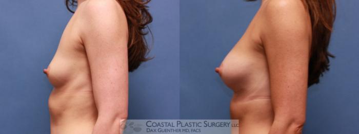 Before & After Breast Augmentation Case 34 View #3 View in Boston, MA