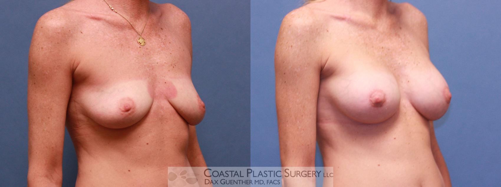 Before & After Breast Augmentation Case 39 View #1 View in Hingham, MA