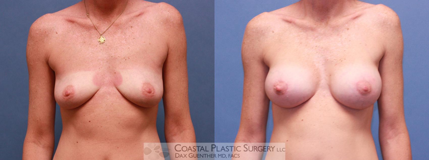 Before & After Breast Augmentation Case 39 View #2 View in Hingham, Boston & Nantucket, MA