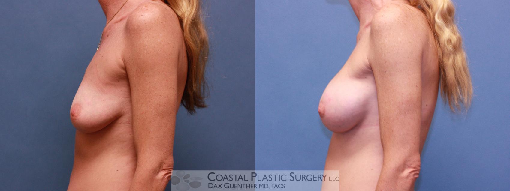 Before & After Breast Augmentation Case 39 View #3 View in Hingham, Boston & Nantucket, MA