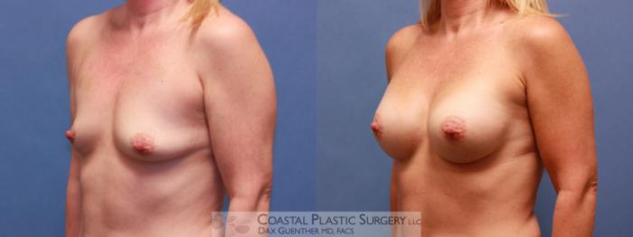 Before & After Breast Augmentation Case 40 View #1 View in Hingham, MA