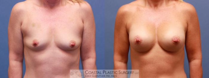 Before & After Breast Augmentation Case 40 View #2 View in Boston, MA