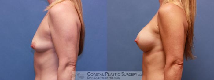 Before & After Breast Augmentation Case 40 View #3 View in Boston, MA