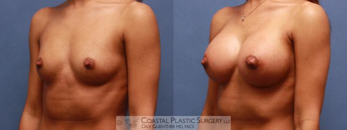 Before & After Breast Augmentation Case 46 View #1 View in Hingham, MA