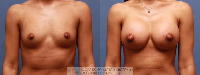 Before & After Breast Augmentation Case 46 View #2 View in Boston, MA
