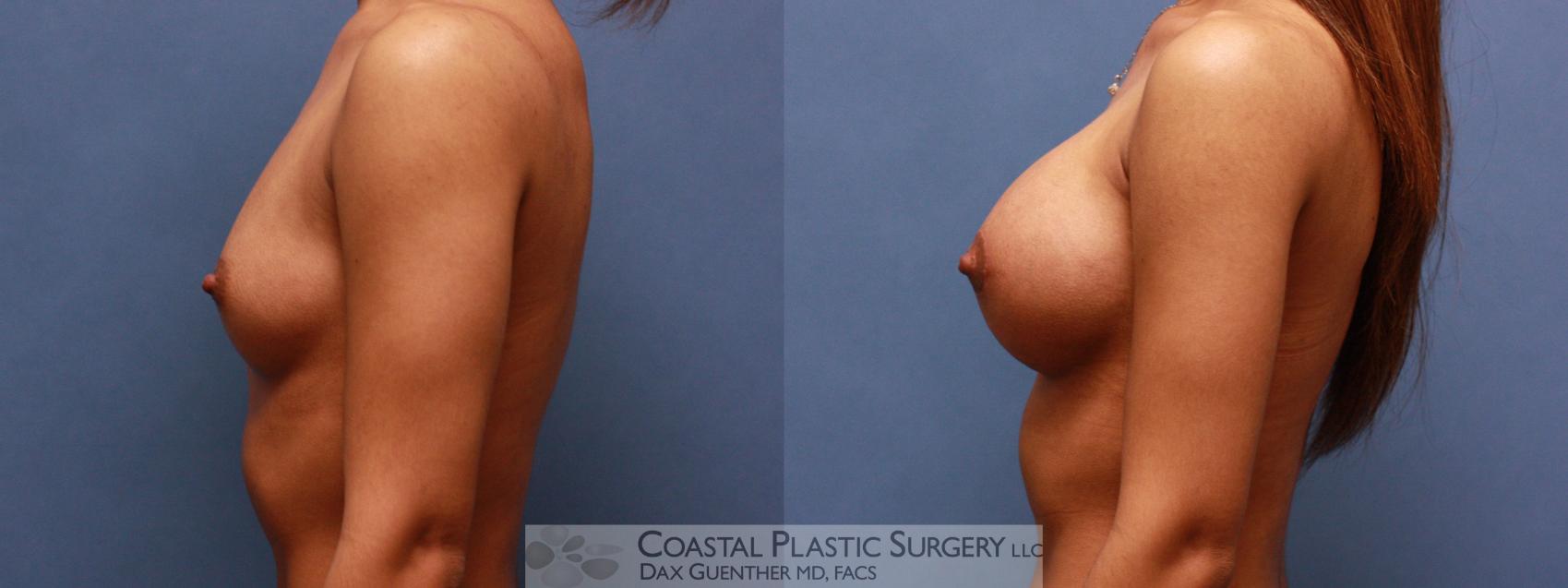Before & After Breast Augmentation Case 46 View #3 View in Boston, MA