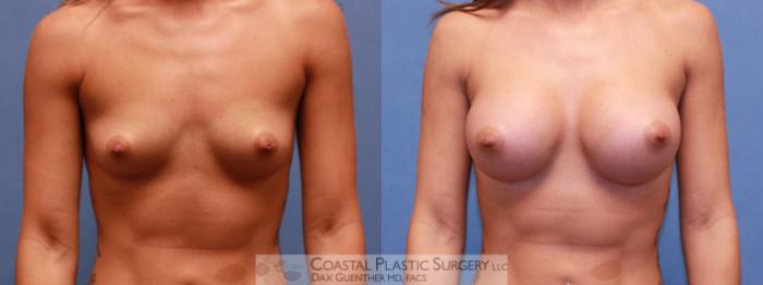 Before & After Breast Augmentation Case 48 View #4 View in Boston, MA