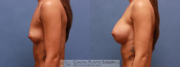 Before & After Breast Augmentation Case 48 View #5 View in Boston, MA