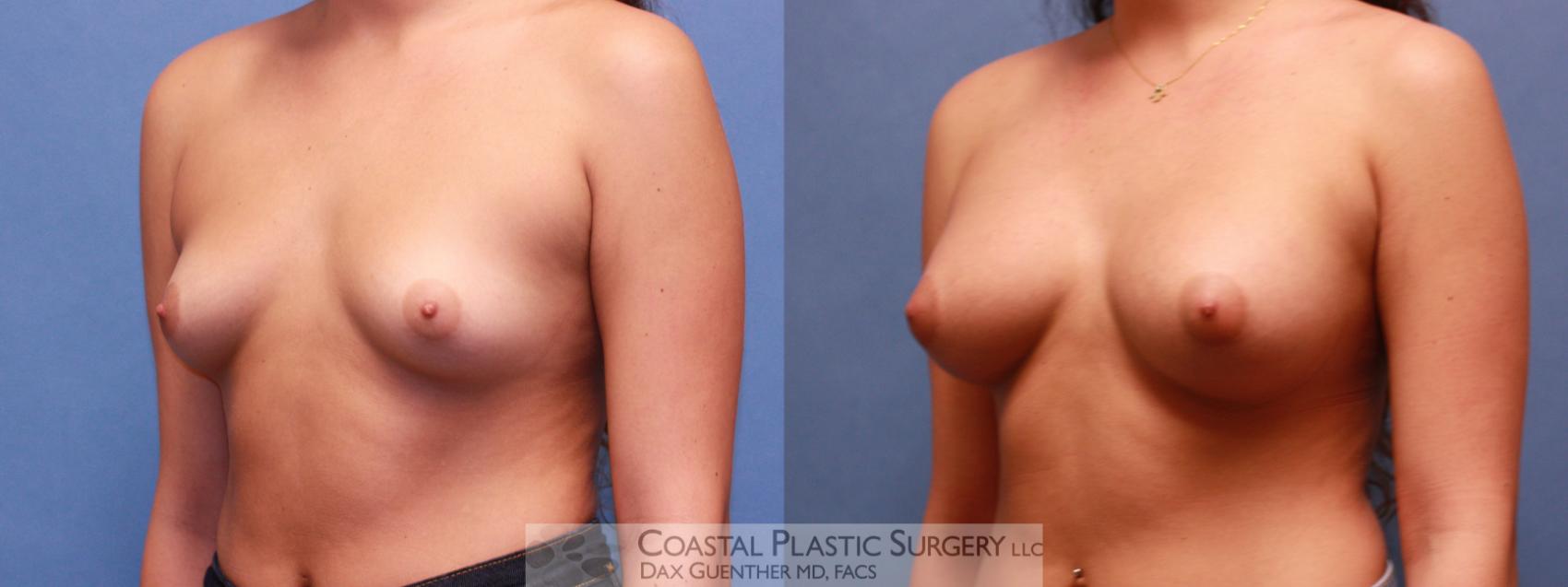 Before & After Breast Augmentation Case 57 View #1 View in Boston, MA