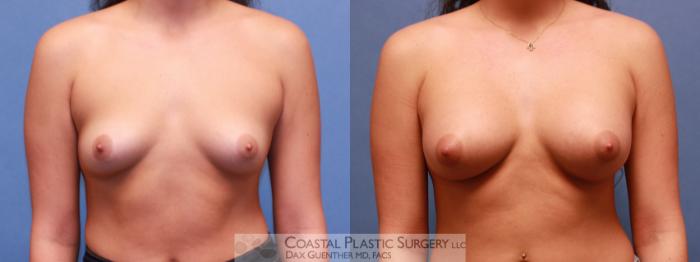 Before & After Breast Augmentation Case 57 View #2 View in Hingham, MA