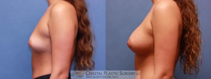 Before & After Breast Augmentation Case 57 View #3 View in Hingham, MA