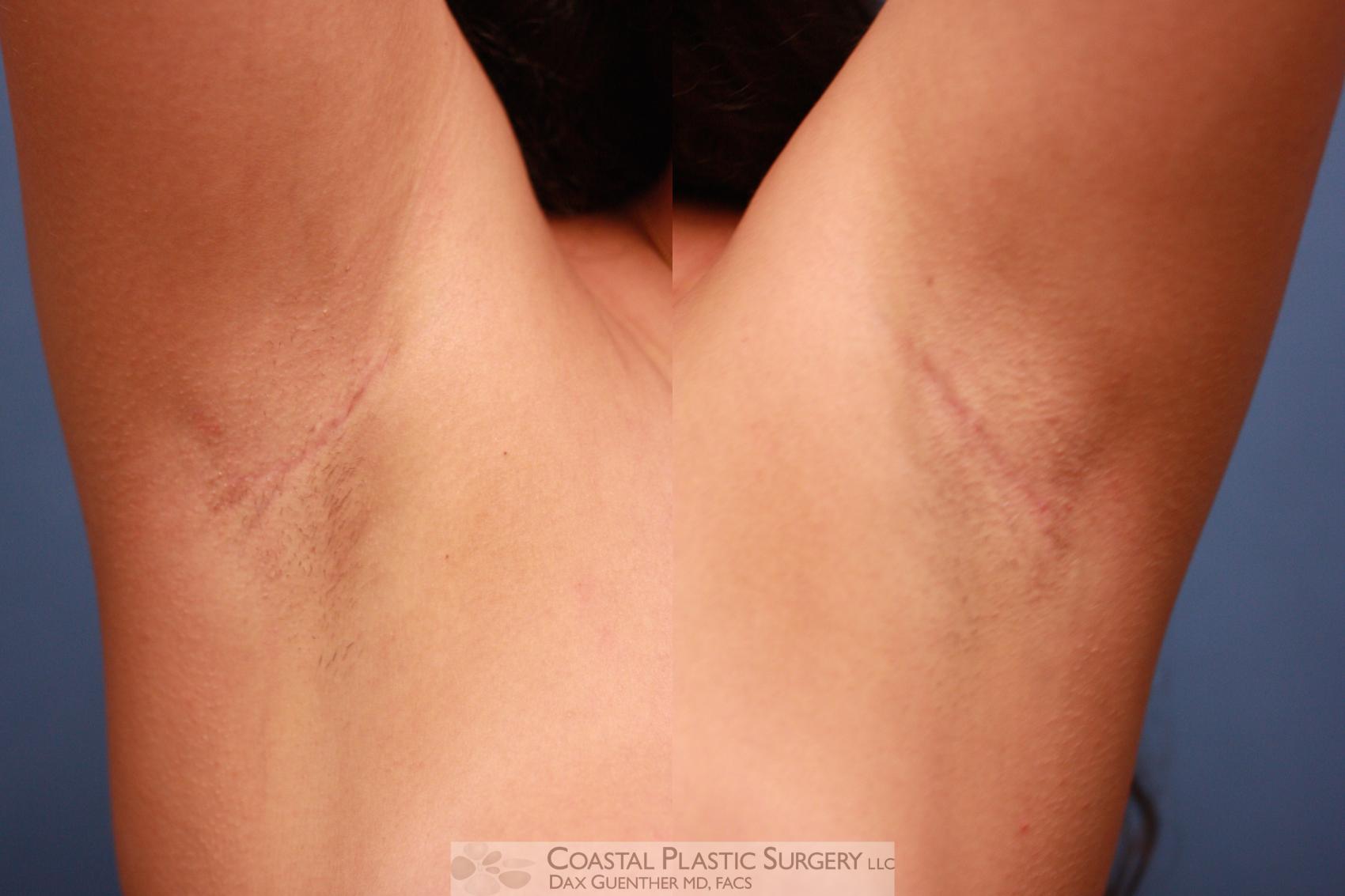 Before & After Breast Augmentation Case 57 View #4 View in Boston, MA