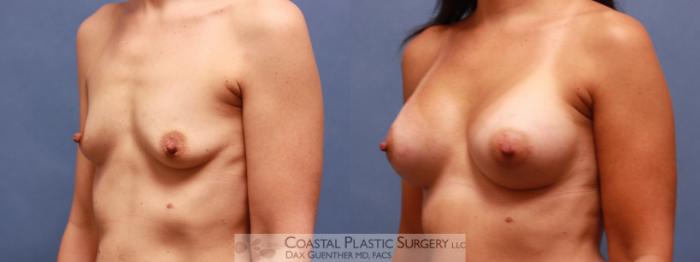 Before & After Breast Augmentation Case 65 View #1 View in Hingham, MA