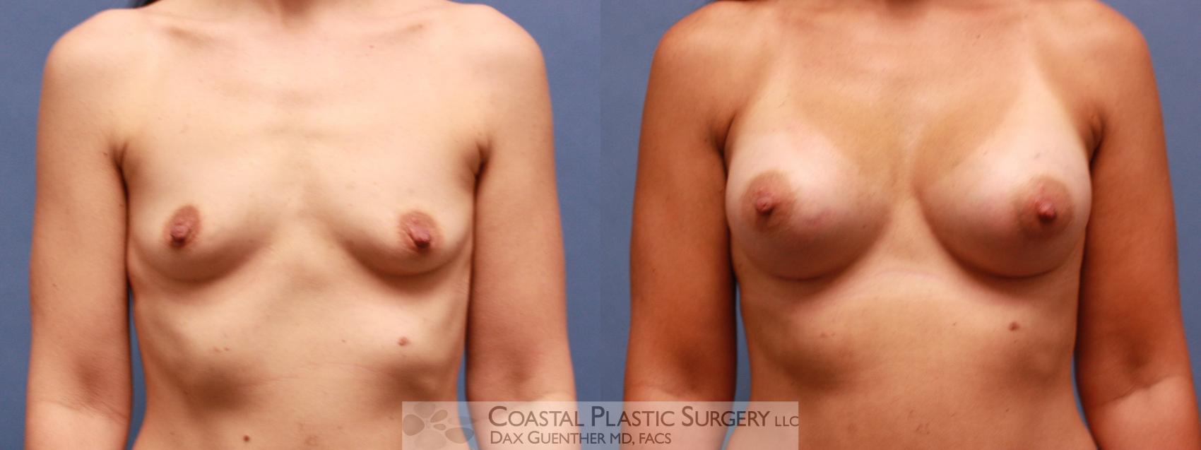 Before & After Breast Augmentation Case 65 View #2 View in Hingham, Boston & Nantucket, MA