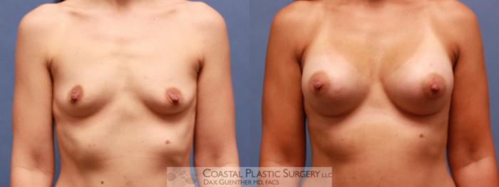 Before & After Breast Augmentation Case 65 View #2 View in Boston, MA