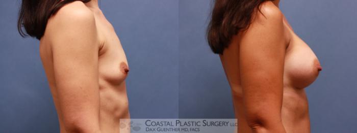 Before & After Breast Augmentation Case 65 View #3 View in Boston, MA
