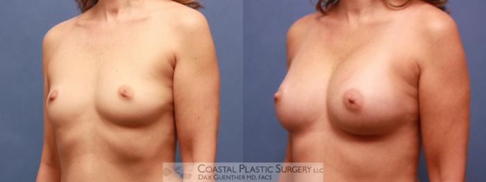 Before & After Breast Augmentation Case 69 View #1 View in Hingham, MA