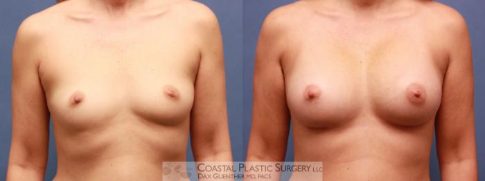 Before & After Breast Augmentation Case 69 View #2 View in Boston, MA