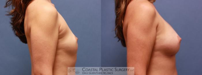 Before & After Breast Augmentation Case 69 View #3 View in Boston, MA